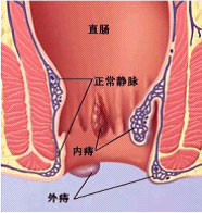 痔疮