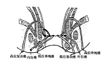 肛瘘形成