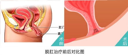 脱肛