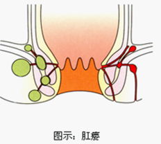 肛瘘图示