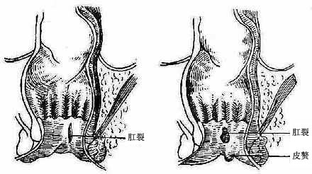 肛裂