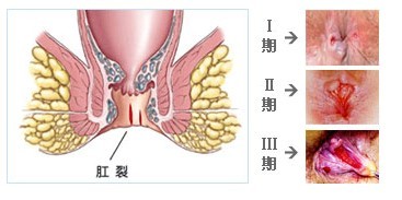 肛裂