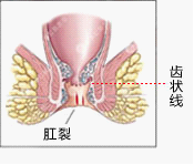 肛裂