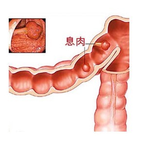 结肠息肉