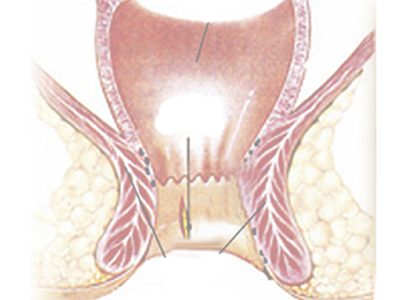 肛门湿疹