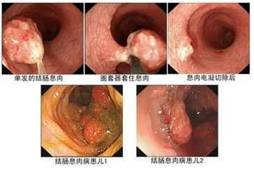 结肠息肉