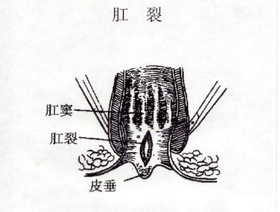 肛裂病理图