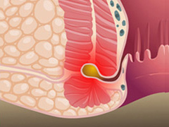 肛瘘病理图