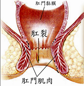 肛裂