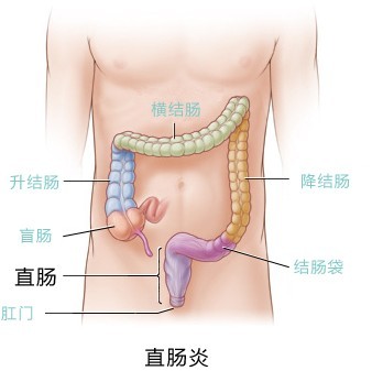 直肠炎原因