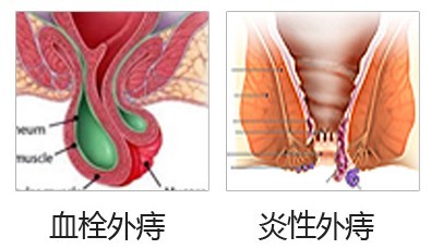 外痔预防