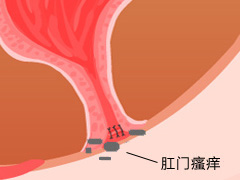 肛门瘙痒征兆、