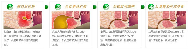 肛周脓肿症状