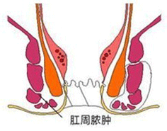 肛周脓肿