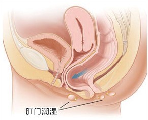 肛门潮湿并发症