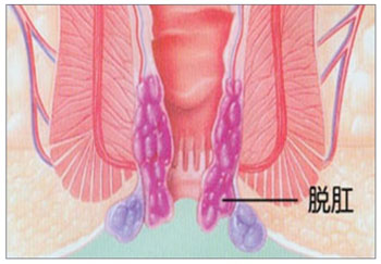脱肛症状