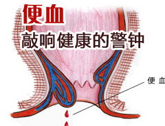 便血症状