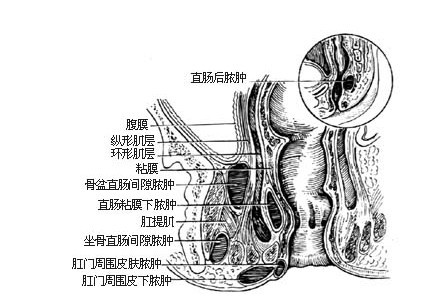 肛周脓肿危害