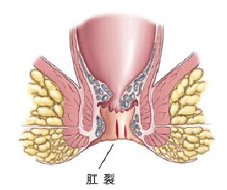 肛裂原因