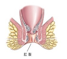 肛裂原因