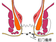 肛门瘙痒症状