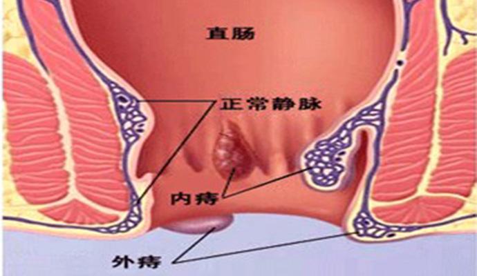 混合痔原因