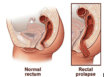 直肠脱垂
