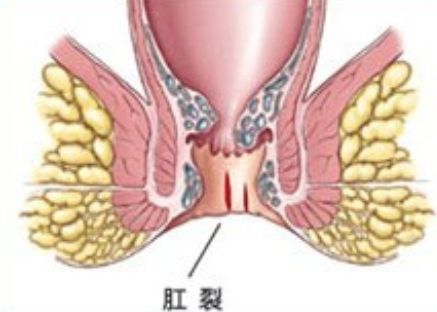 肛裂原因