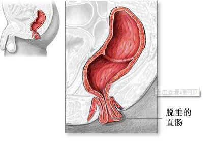 直肠脱垂